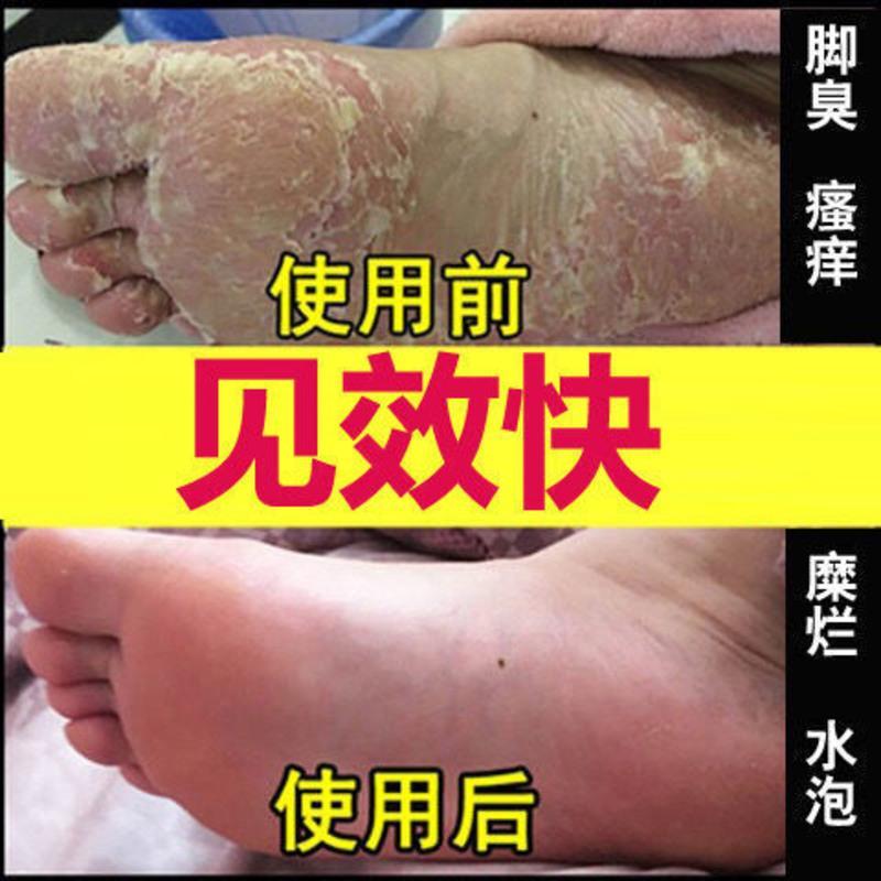 狼毒套装[一盒体验装] 狼毒脚气王喷剂脚气膏脚臭脚痒治香港脚脱皮烂脚脚藓脚臭克星水泡