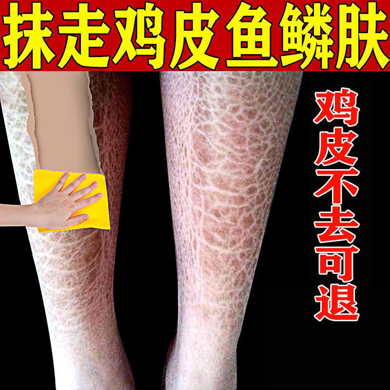 [一抹掉光鸡皮]鱼鳞皮肤霜草本润肤保湿皮肤干燥身体乳皮肤修复 一瓶[开始体验装]