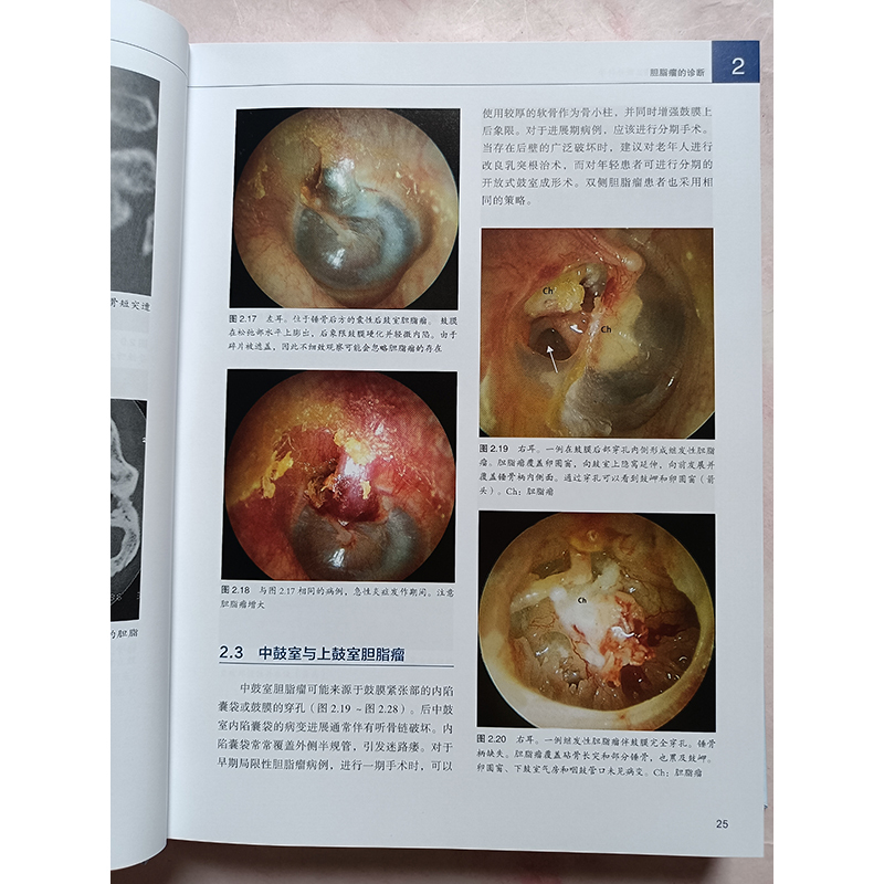 [正版]中耳与岩骨胆脂瘤显微外科学 中耳的应用解剖 影像技术 岩部胆脂瘤分类 手术径路的选择 手术操作 中耳和颞骨岩部胆