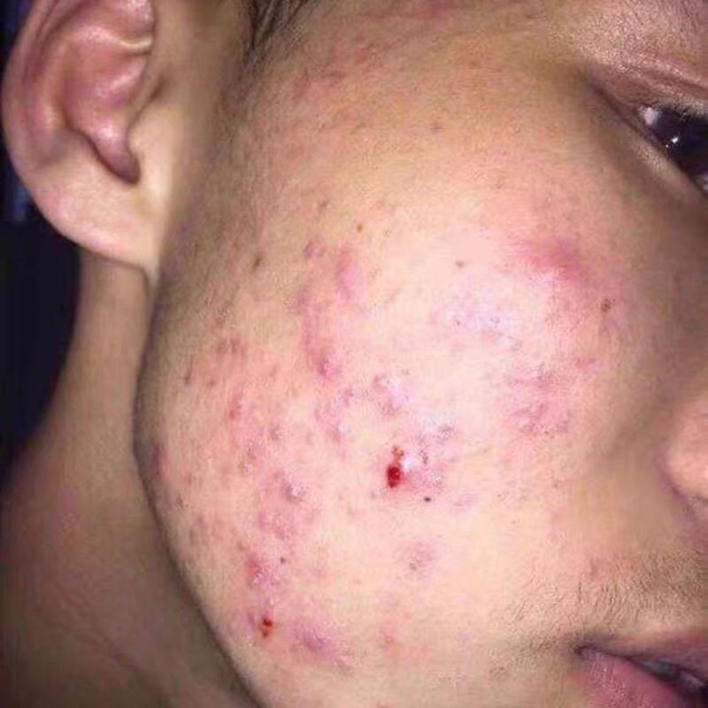 去痘坑凹洞填充祛疤膏去痘印修复霜痘疤女痘坑男士祛痘印淡化痘痕单