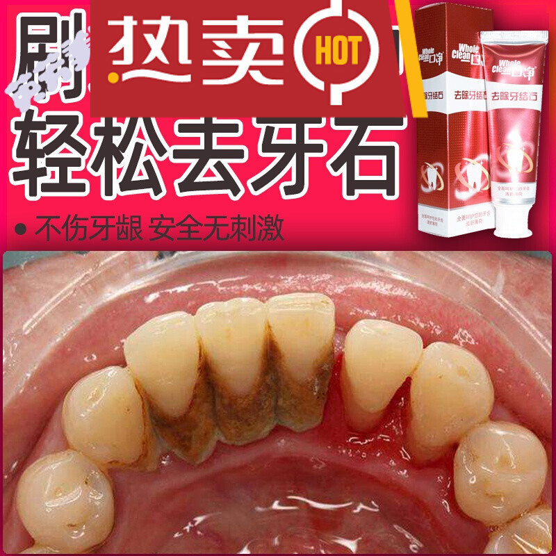 去牙结石速效牙膏溶解牙石漱口洁牙慕斯去牙烟渍家用去除牙石生物溶菌