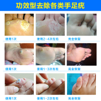 [顽固断除型]脚医生正品祛尤卫士膏液套装脚底上肉刺猴子刺猴寻常尤疣瘊净鸡眼去疣灵足部老茧脚垫胼胝止尤净丝状疣止疣净