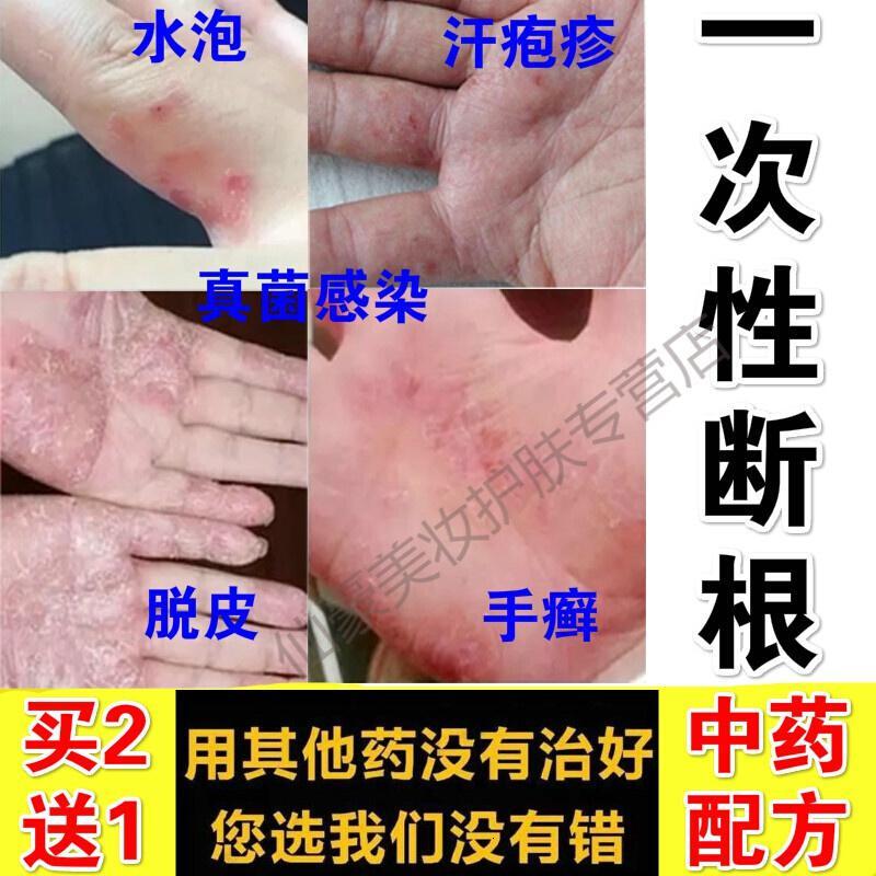 鹅掌风手癣膏手足癣真菌感染脱皮干裂水泡湿疹止痒去根鹅掌风箹膏膏