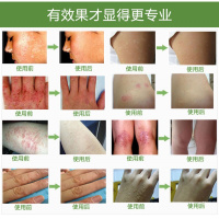 溼疹成人神經性皮炎牛皮蘚癬外用药膏老偏方囊止痒股蘚癬无