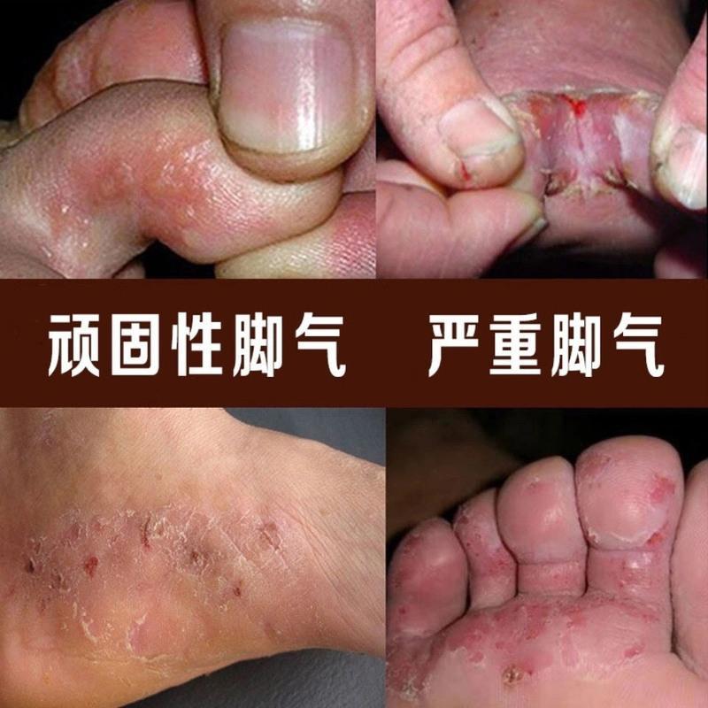 狼毒脚气王喷剂治脚气膏喷雾去除脚臭脚痒烂脚丫水泡脱皮脚汗克星