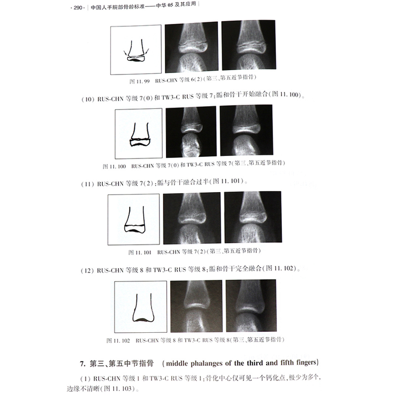 [醉染正版]中国人手腕部骨龄标准-中华05及其应用 看骨龄图谱鉴定分析 临床医学法医学运动领域儿童青少年生长发育评价医师高清大图