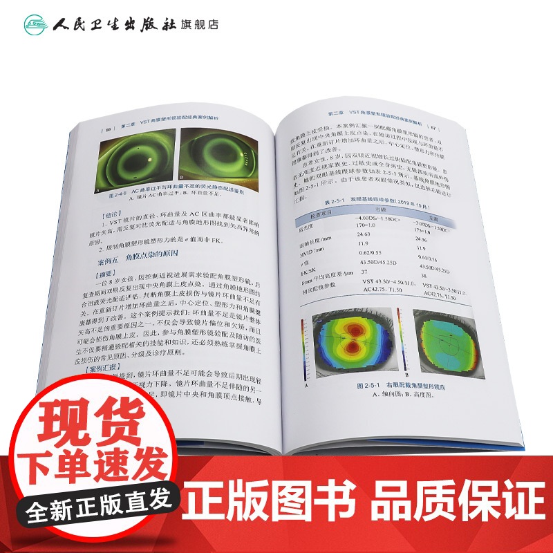 角膜塑形镜验配经典案例解析第2辑陈志配镜原则vst镜片crt近视控制技术矫正OK激光标记白内障参数识别地形图选择采集点染高清大图