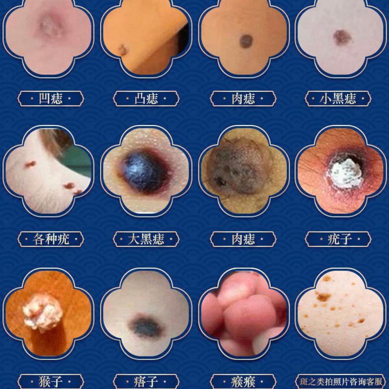 去痣神器无痛脸部除黑痣点痣膏不留疤无痕学生祛痣去瘊子肉