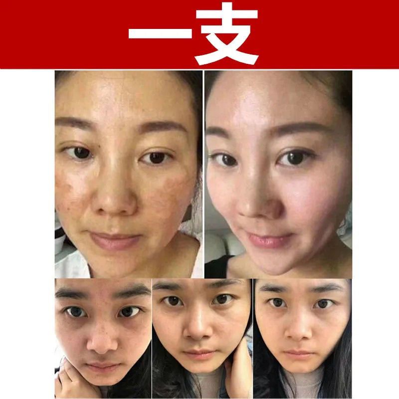一盒装【小斑点使用】 去班黑斑色斑老年斑男士女专用祛斑霜斑点神器淡化黑色素沉淀脸部