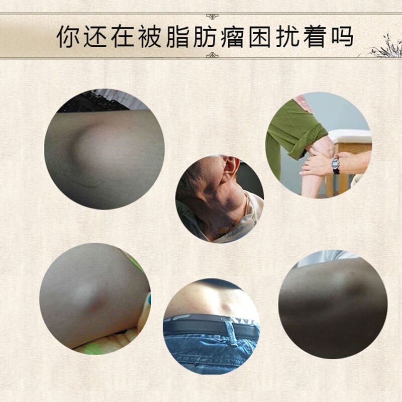 脂肪瘤膏去皮下多发性脂肪瘤去除调理脂肪瘤消瘤膏去皮下脂肪瘤