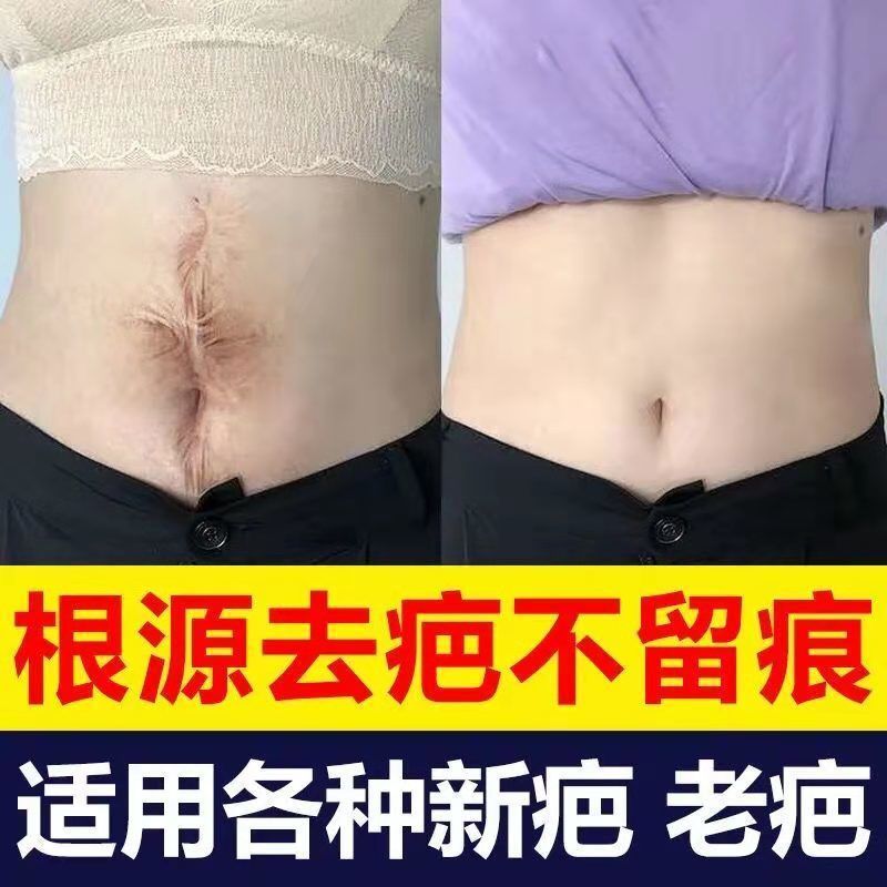 [快速去疤]淡化增生凹凸疤妊娠纹去新老疤烧伤痘印疤膏修复无痕 升级装一瓶装