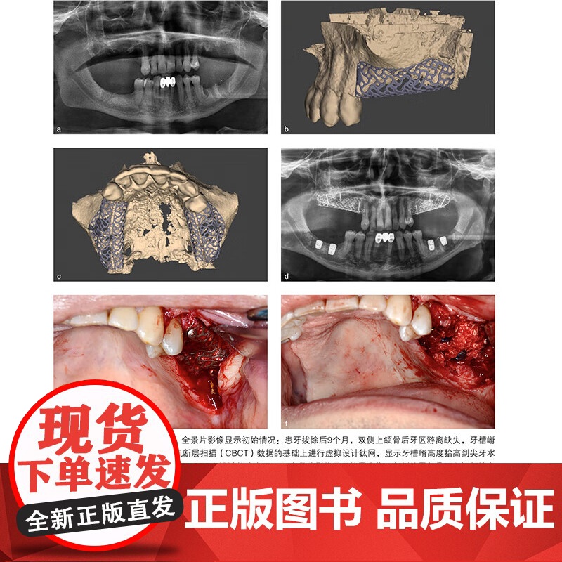 [出版社]口腔种植骨增量手术精要(德)亨德里克·特海登 生物学原则外科手术技巧临床挑战9787559140203辽宁科学高清大图