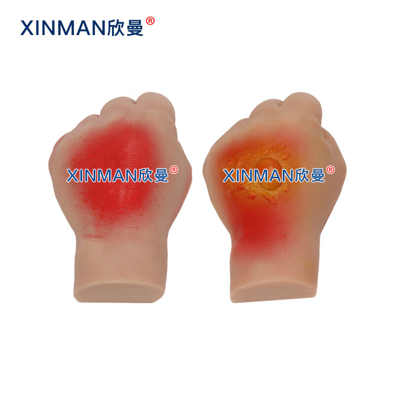 欣曼科教 人员中毒仿真模型 神经性中毒 芥子气中毒 路易氏剂中毒 教学用模型XM-SQ16A高清大图