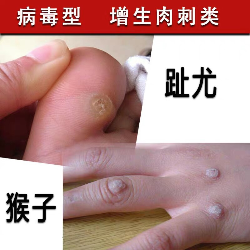 治猴子的鱼修子趾尤老茧鱼鳞痣脚垫除刺猴贴手足尤烂痣膏
