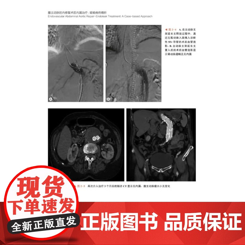 DF[央视网]腹主动脉腔内修复术后内漏治疗:疑难病例精析 9787523601679 中国科学技术出版社 内科学 大动脉高清大图
