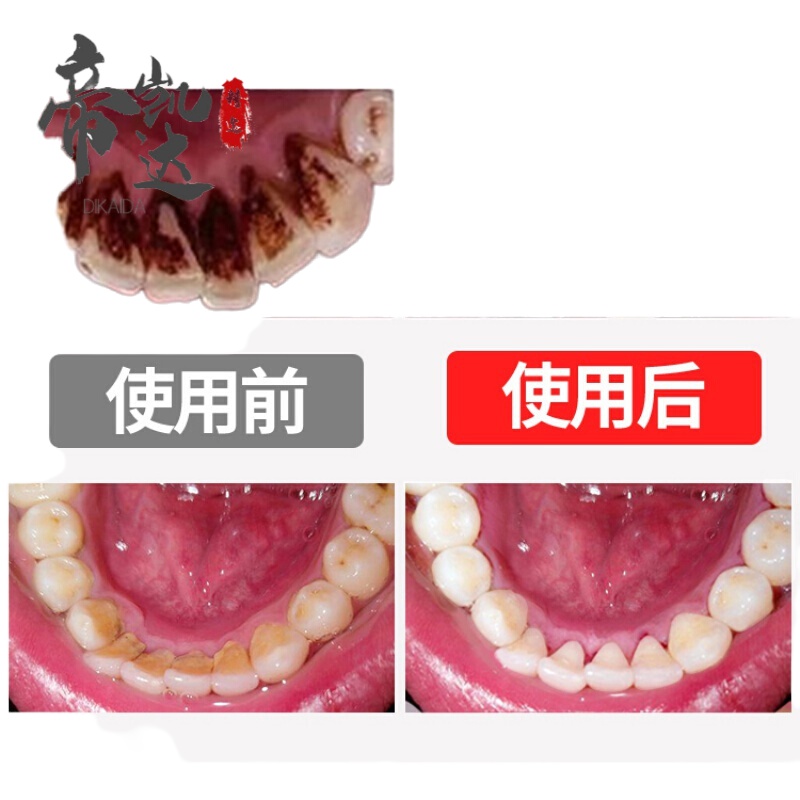 [苏宁专营]牙结石牙膏溶解牙去石速效漱口洁牙慕斯去牙家用去除洁牙慕斯qu牙石 120g烟 精选特买