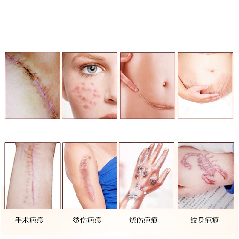 颜清克抚痕修复凝胶脸部痘痘印黑红痘印痘坑背部痘印米美云贝净痕云米肤研坊冷敷凝胶