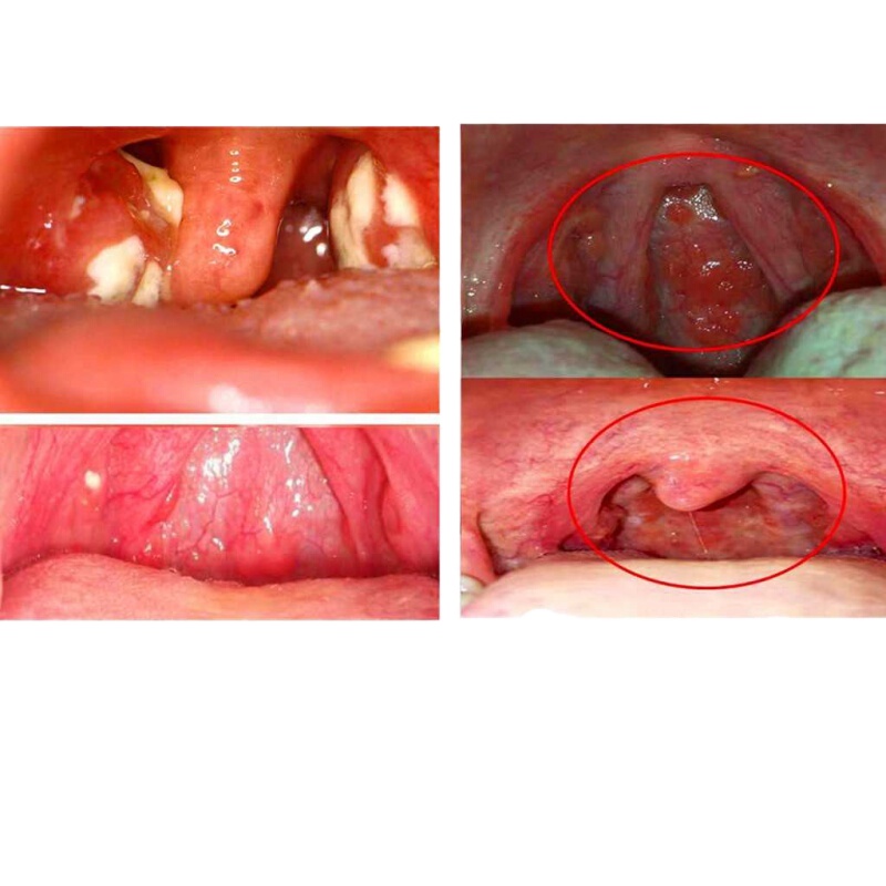 咽喉炎慢性咽炎喷雾急慢性除根咽炎滤泡增生咽喉异物感喷剂